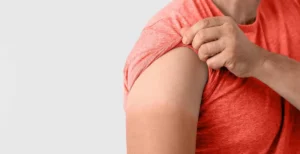 Read more about the article Kulit Belang Menjadi Pengganggu, Bagaimana Cara Mengatasinya?